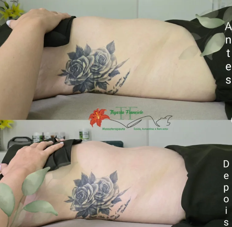 Comparação antes e depois da região lateral do abdômen em sessão de redução de medidas